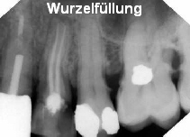 Wurzelfüllung Wurzelfüllung