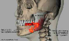 Triggerpunkt Masseter