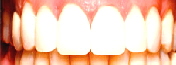 Veneers